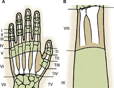 Management Of Complications Of Extensor Tendon Injuries Hand Clinics