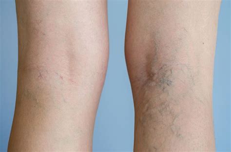 Harvard Trained Vein Doctors Whats The Average Spider Vein Removal Cost