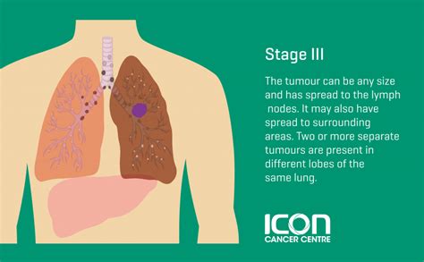 Lung Cancer Types Stages Icon Cancer Centre Singapore