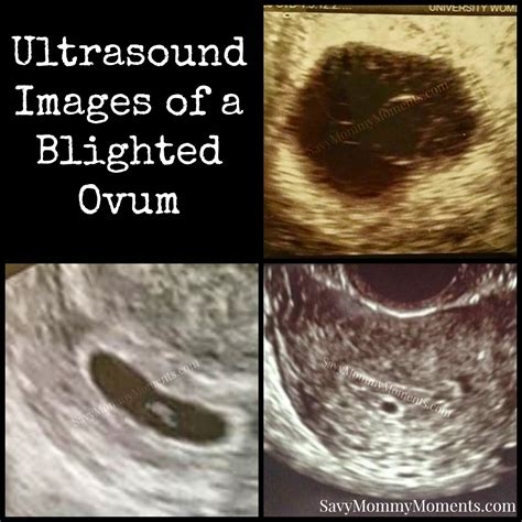 Blighted Ovum Pregnancy After Pregnancy