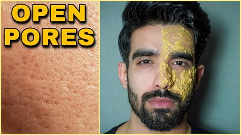 How To Get Rid Of Large Open Pores Naturally Shrink Large Pores