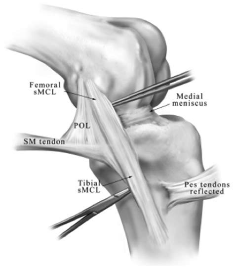 Ligaments Of The Knee Recon Orthobullets