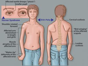 Brachial Plexus Injury Physioline