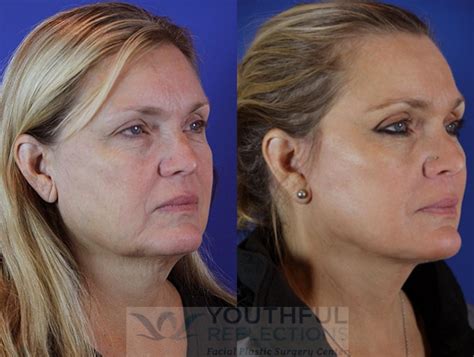 Wahrnehmbar Sicherheit In Der Gnade Von Co2 Laser Before And After Pics