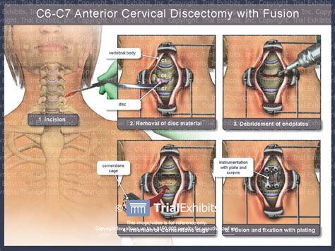 C6 C7 Anterior Cervical Discectomy With Fusion Trialexhibits Inc