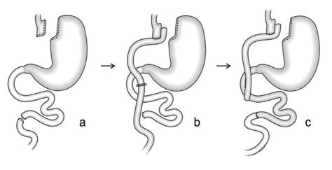 Roux En Y Gastric Bypass Modified By The Inclusion Of The Duodenum And