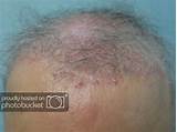 Images of Hair Loss On Both Sides Of Head