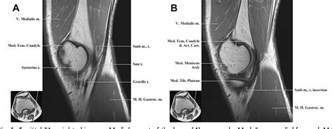 Figure 6 From Normal Mr Imaging Anatomy Of The Knee Semantic Scholar