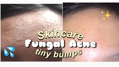 Skincare For Fungal Acne Or Tiny Bumps Philippines Youtube