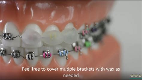 How To Use Dental Wax On Braces Evolution Orthodontics Youtube