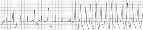 V Tach Ecg Strip