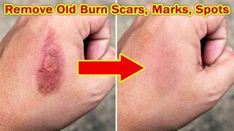 It can persist for 6 months or more and may vary based on the intensity of the wound and also depends on healing process. Best Way To Get Rid Of Old Burn Scars, Burn Marks ...