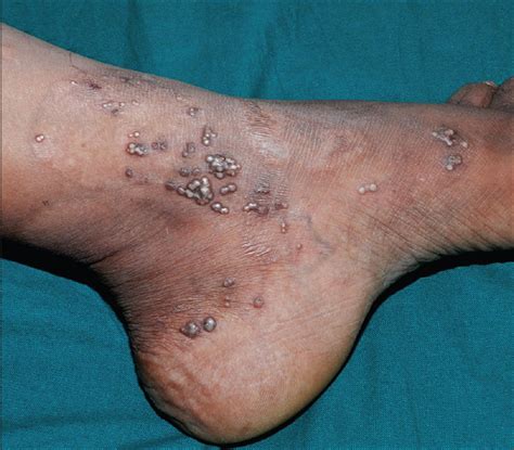 Extensive Milia Formation In A Young Woman With Bullous Pemphigoid