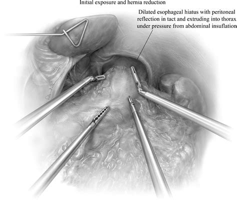 References In Robotic Assisted Giant Paraesophageal Hernia Repair And Nissen Fundoplication