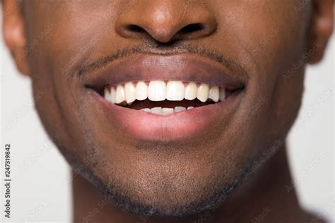 Foto De Close Up View Of Beaming Orthodontic White Wide Male Smile African Black Man With