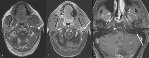 Imaging Of Salivary Gland Pathology Operative Techniques In