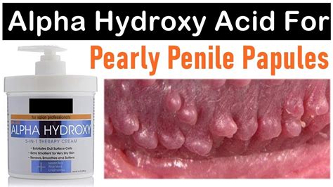 Alpha Hydroxy Acid For Pearly Penile Papules Effective Or Not Youtube