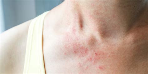 What Is The Main Cause Of Eczema Cubaheal Medical Tourism