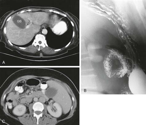 Anomalies And Anatomic Variants Of The Gallbladder And Biliary Tract