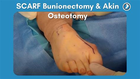 Scarf Bunionectomy And Akin Osteotomy Youtube
