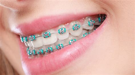 Metal Braces Im Orthodontics