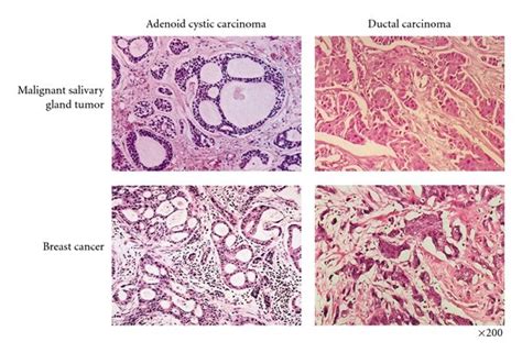 Histological Comparison Of Malignant Salivary And Mammary Gland Tumors