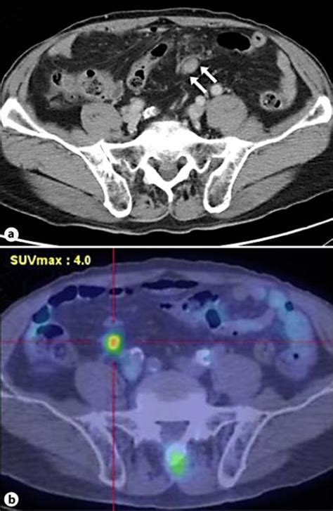 Abdominal Ct Scan Showed Swollen Regional Mesenteric Lymph Node