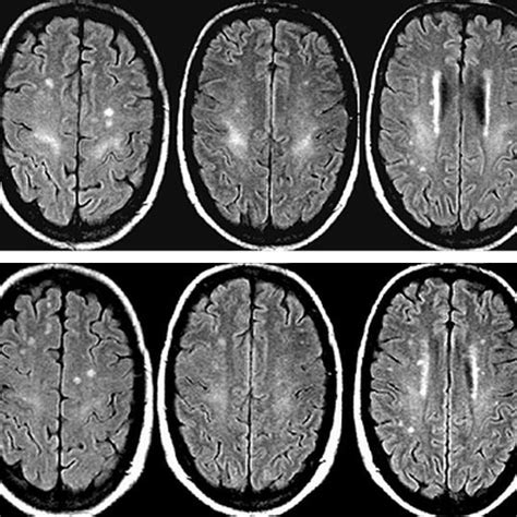 Pdf Mr Imaging Findings In Hepatic Encephalopathy