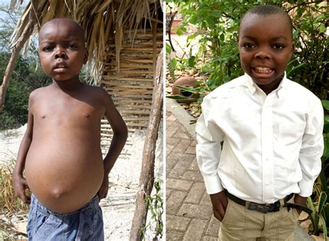 Kwashiorkor Malnutrition