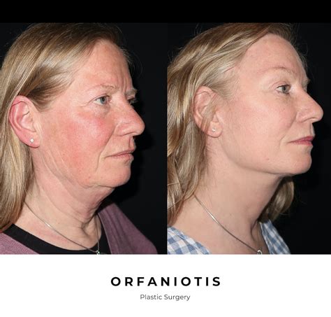 Deep Plane Facelift In London Georgios Orfaniotis