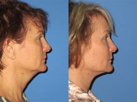 Face And Neck Liposuction Tampa Elite