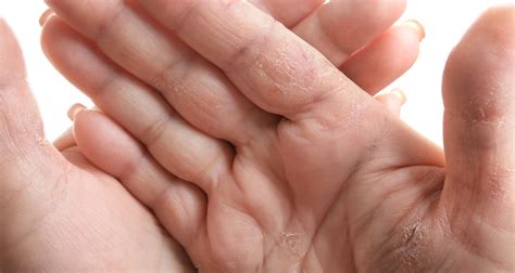 Washing your hands more? Get help for dry, cracking hands ...