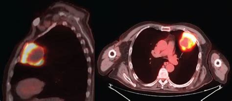 Chest Wall Resectionreconstruction For Tumors Master Techniques In