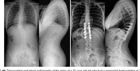 Figure 1 From Congenital Scoliosis Treated With Posterior Vertebral