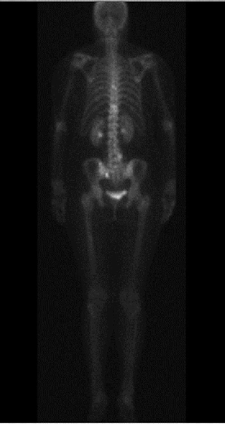 Spect Bone Scan Showing Pathologic Uptake In The Vertebras Sternum And
