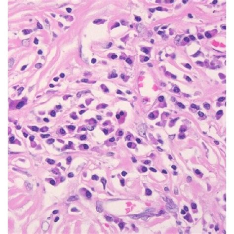 Igg4 Related Lymphadenopathy Type I A The Lymph Node Shows