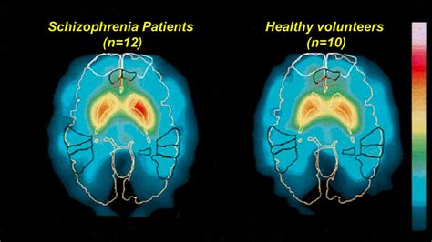 Does Schizophrenia Show On A Brain Scan
