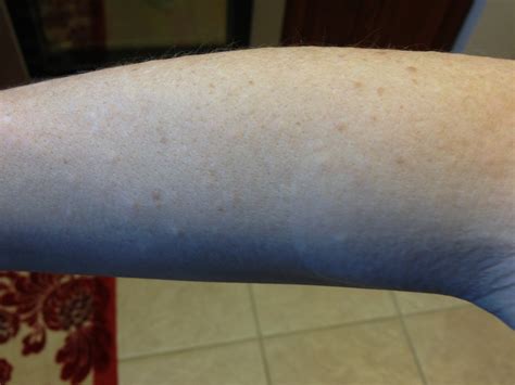 I Have A Rash That Started On My Forearms In Tiny Red Spots E89