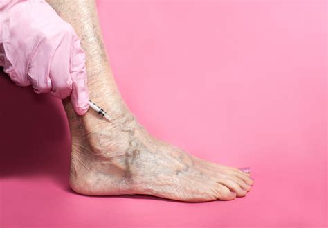 Treating Spider Veins In The Feet And Ankles The Vein Center Of Maryland