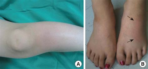 Skin Lesions Of Our Patient With Eosinophilic Cellulitis A