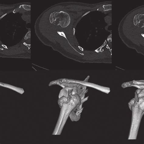 The Clinical View Of A 3 Weeks Neglected Bilateral Anterior Shoulder