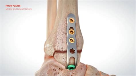 Ortholoc™ 3di Ankle Fracture Lp System Animation 015666 Broadcastmed