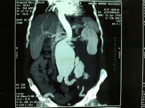 Abdominal Computed Tomography Ct Scan With Iv Contrast Demonstrates