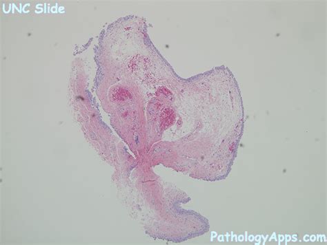 Papillary Cystitis Pathology