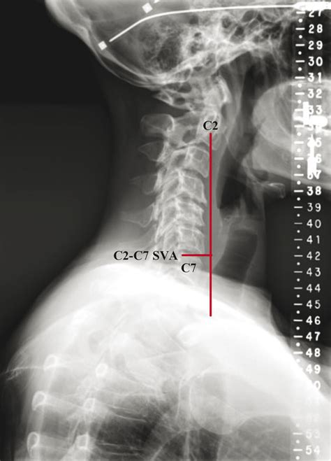 16 Cervical Sagittal Alignment And Cervicarthrosis Neupsy Key