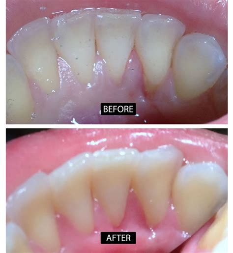 Before And After Periodontics Annandale North Va Prestige Dental