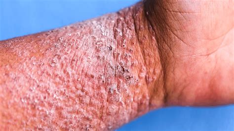 Eczema Rash Look Like