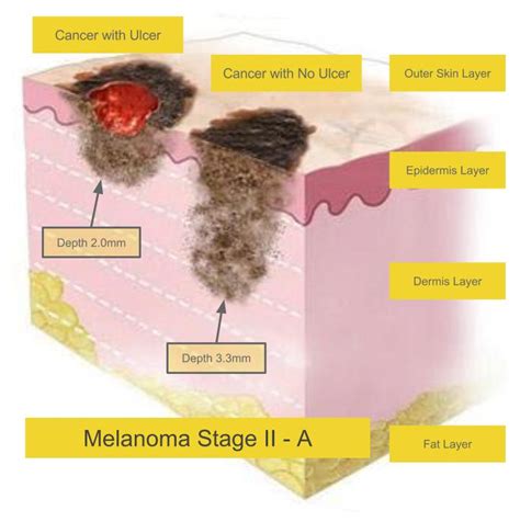 Melanoma Symptoms Stage 2 Doctor Heck