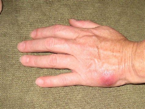 Spider Bite Pictures Appearance And Emergency Signs