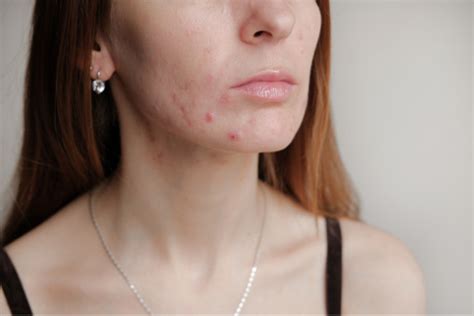 3 Weeks Treatment For Tiny Bumps Acne On Your Face Glowpink